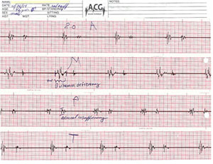 Acoustic Cardiograph Graph