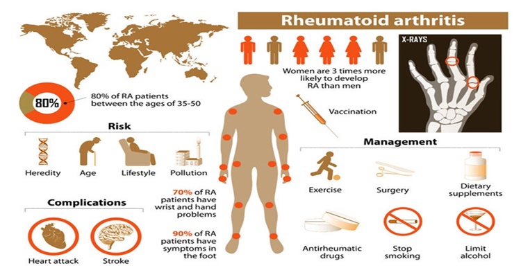 Managing rheumatoid arthritis naturally