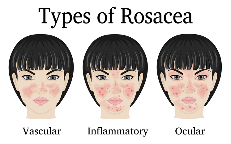 Rosacea