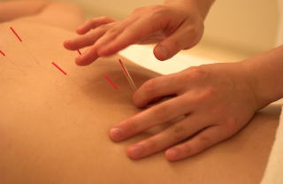 Acupuncture