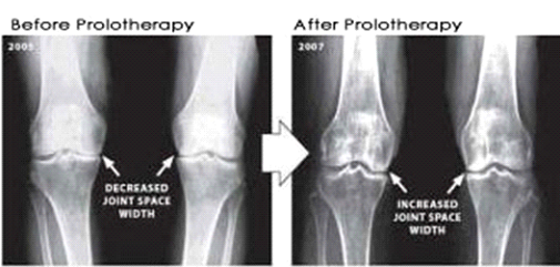 prolotherapy before and after