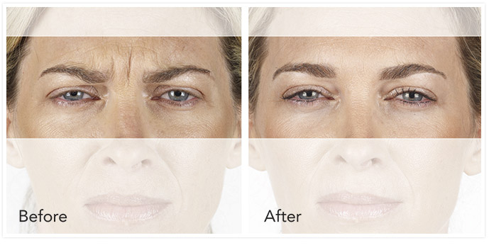 Vancouver Xeomin Cosmetic
